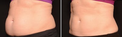 CoolSculpting Before & After Gallery - Patient 5750417 - Image 1
