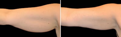 CoolSculpting Before & After Gallery - Patient 5750418 - Image 1