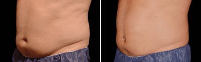 CoolSculpting Before & After Gallery - Patient 5750419 - Image 1