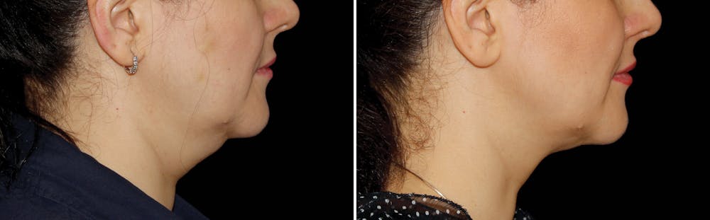 CoolSculpting Before & After Gallery - Patient 5750424 - Image 1