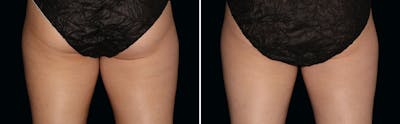 CoolSculpting Before & After Gallery - Patient 5750421 - Image 1