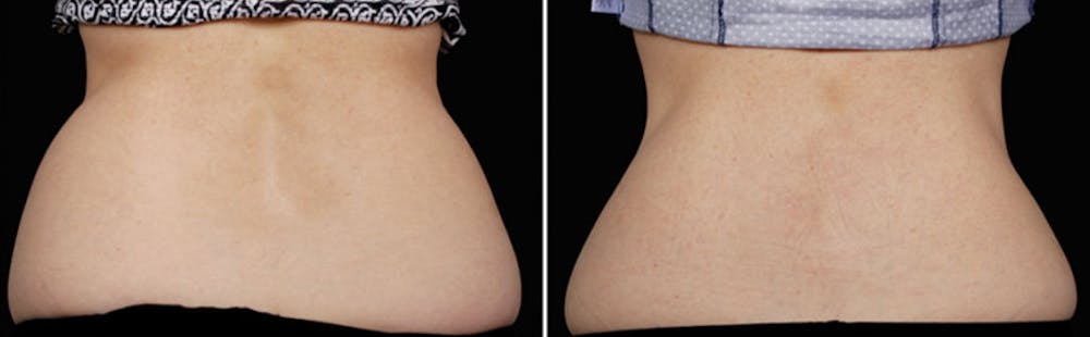 CoolSculpting Before & After Gallery - Patient 5750422 - Image 1