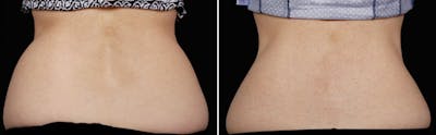 CoolSculpting Before & After Gallery - Patient 5750426 - Image 1