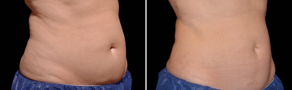 CoolSculpting Before & After Gallery - Patient 5750427 - Image 1