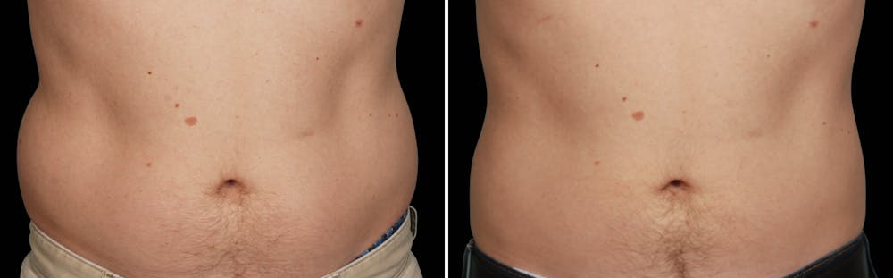 CoolSculpting Gallery - Patient 5750428 - Image 1