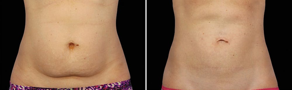 CoolSculpting Before & After Gallery - Patient 5750429 - Image 1