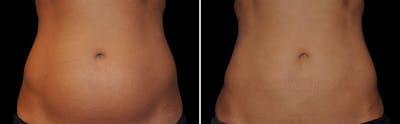 CoolSculpting Before & After Gallery - Patient 5750430 - Image 1