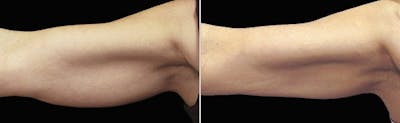 CoolSculpting Before & After Gallery - Patient 5750431 - Image 1