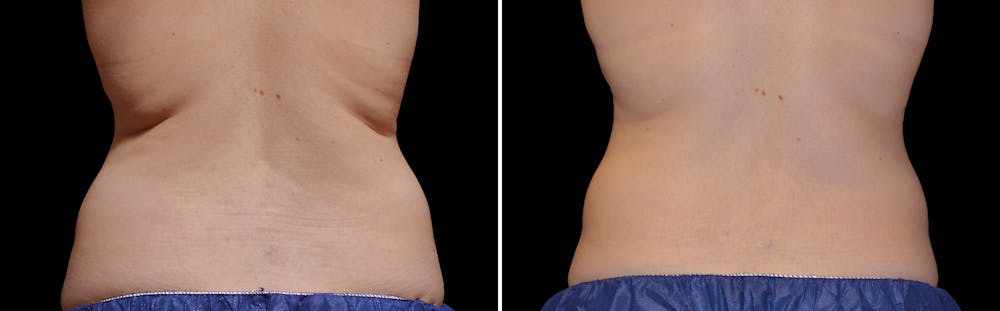 CoolSculpting Gallery - Patient 5750432 - Image 1