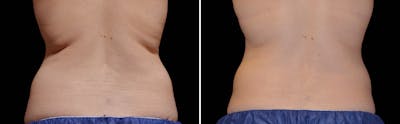 CoolSculpting Before & After Gallery - Patient 5750432 - Image 1
