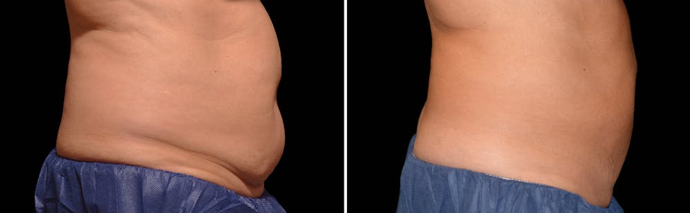 CoolSculpting Gallery - Patient 5750433 - Image 1