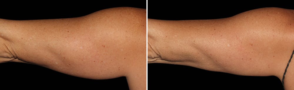 CoolSculpting Before & After Gallery - Patient 5750434 - Image 1