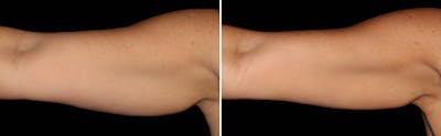 CoolSculpting Before & After Gallery - Patient 5750435 - Image 1