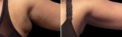 CoolSculpting Before & After Gallery - Patient 5750436 - Image 1