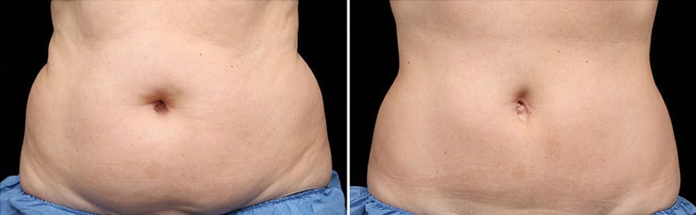 CoolSculpting Before & After Gallery - Patient 5750437 - Image 1