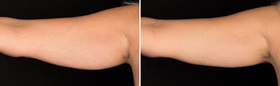 CoolSculpting Before & After Gallery - Patient 5750438 - Image 1