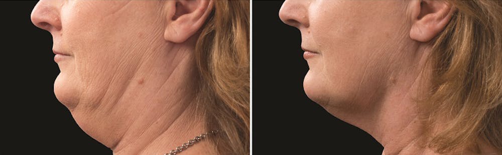 CoolSculpting Before & After Gallery - Patient 5750440 - Image 1