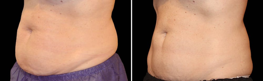 CoolSculpting Gallery - Patient 5750442 - Image 1