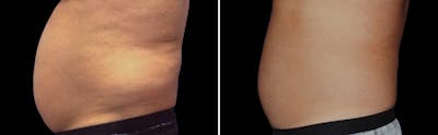 CoolSculpting Before & After Gallery - Patient 5750443 - Image 1