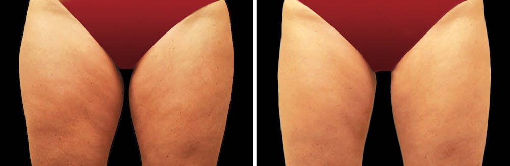 CoolSculpting Before & After Gallery - Patient 5750461 - Image 1