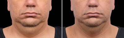 CoolSculpting Before & After Gallery - Patient 5750444 - Image 1