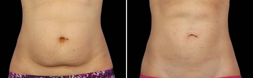 CoolSculpting Before & After Gallery - Patient 5750441 - Image 1