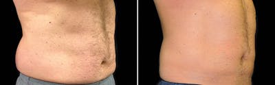 CoolSculpting Before & After Gallery - Patient 5750462 - Image 1