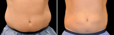 CoolSculpting Before & After Gallery - Patient 5750463 - Image 1