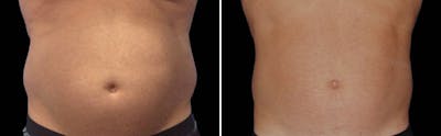 CoolSculpting Before & After Gallery - Patient 5750464 - Image 1