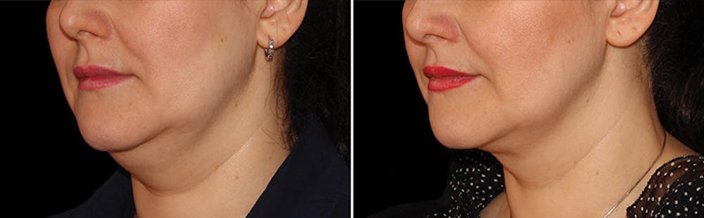 CoolSculpting Before & After Gallery - Patient 5750465 - Image 1