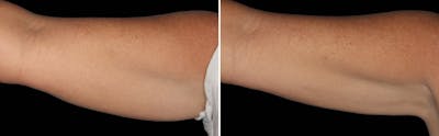CoolSculpting Before & After Gallery - Patient 5750466 - Image 1