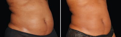 CoolSculpting Before & After Gallery - Patient 5750468 - Image 1