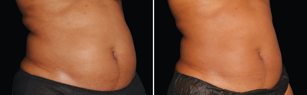 CoolSculpting Gallery - Patient 5750468 - Image 1