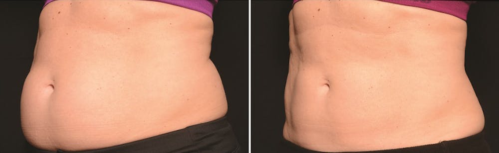CoolSculpting Before & After Gallery - Patient 5750470 - Image 1