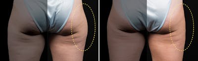 CoolSculpting Before & After Gallery - Patient 5750471 - Image 1