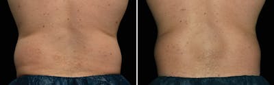 CoolSculpting Before & After Gallery - Patient 5750472 - Image 1