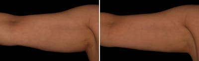 CoolSculpting Before & After Gallery - Patient 5750474 - Image 1