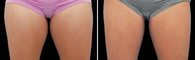 CoolSculpting Before & After Gallery - Patient 5750473 - Image 1