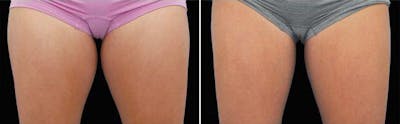 CoolSculpting Before & After Gallery - Patient 5750473 - Image 2
