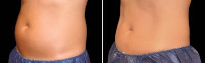 CoolSculpting Before & After Gallery - Patient 5750475 - Image 1
