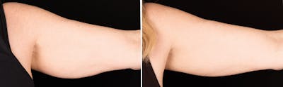 CoolSculpting Before & After Gallery - Patient 5750477 - Image 1