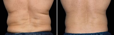 CoolSculpting Before & After Gallery - Patient 5750476 - Image 1
