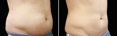 CoolSculpting Before & After Gallery - Patient 5750498 - Image 1