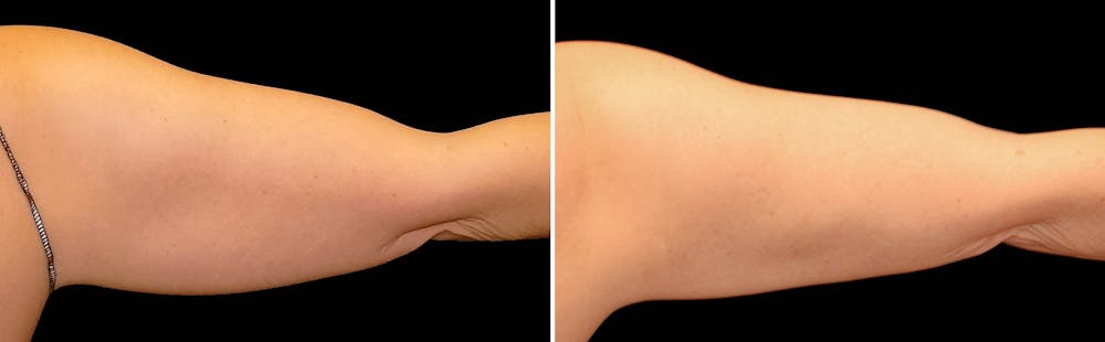 CoolSculpting Before & After Gallery - Patient 5750497 - Image 1