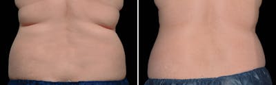 CoolSculpting Before & After Gallery - Patient 5750496 - Image 1