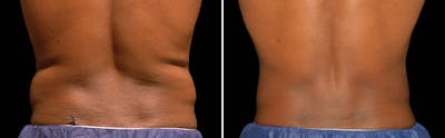 CoolSculpting Before & After Gallery - Patient 5750495 - Image 1