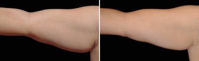 CoolSculpting Before & After Gallery - Patient 5750494 - Image 1