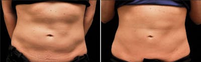 CoolSculpting Before & After Gallery - Patient 5750493 - Image 1