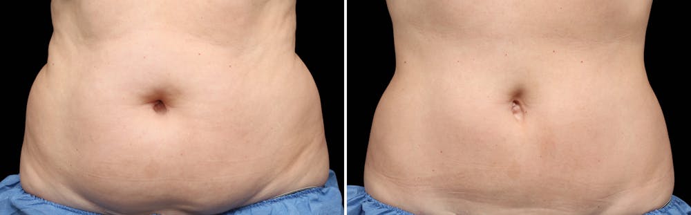 CoolSculpting Gallery - Patient 5750492 - Image 1