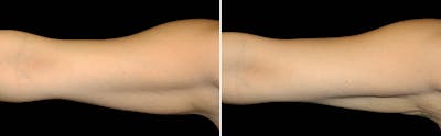 CoolSculpting Before & After Gallery - Patient 5750491 - Image 1